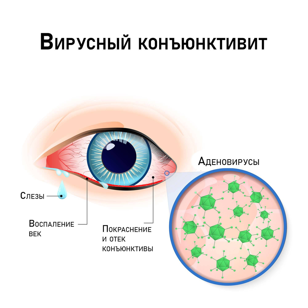 Аденовирусная инфекция конъюнктивит. Клинические проявления аденовируса. Конъюнктивит при аденовирусной инфекции. Аденовирусная инфекция проявления.