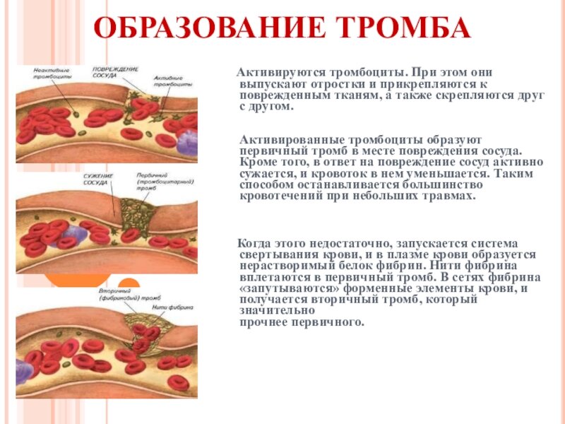Части тромбов. Схема образования тромбоцитарного тромба. Тромбоциты крови тромб образование. Процесс образования тромба в крови. Формирование кровяного сгустка.
