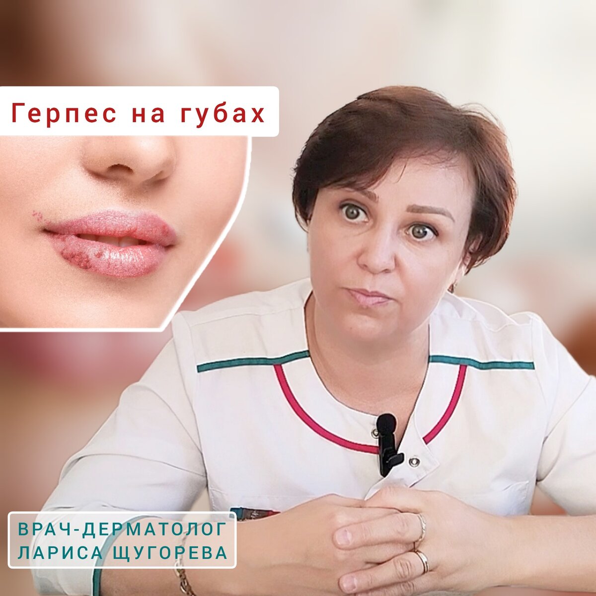 Герпес на губе | Причины, Симптомы, Лечение и Профилактика | DentalOpera