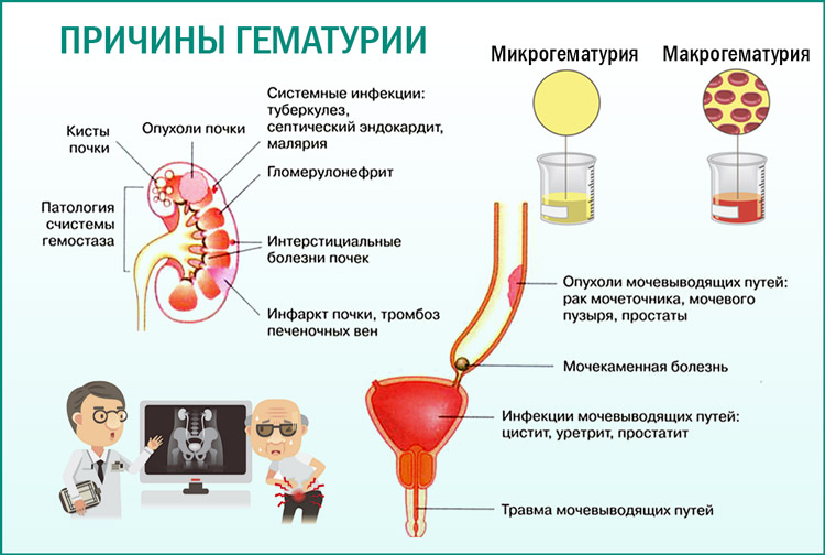 Кровь у мужчины из мочевого. Мочекаменная болезнь гематурия.