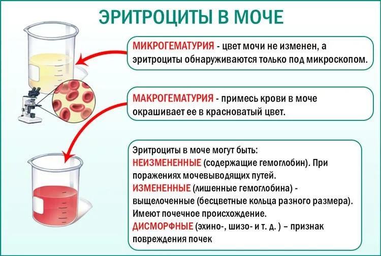 Кровь в моче: возможные причины