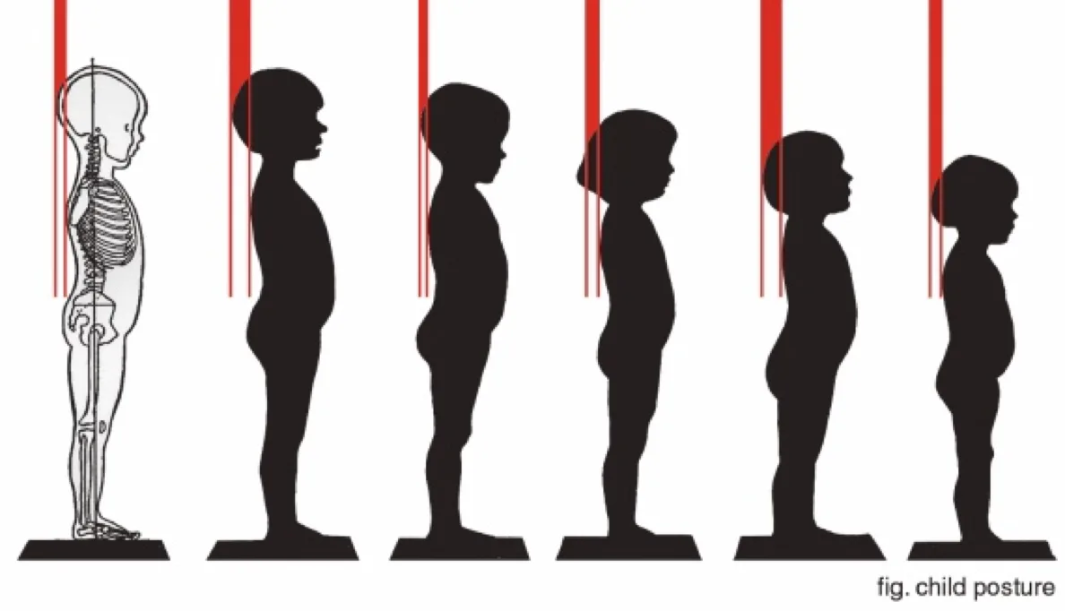 Осанка ребенка 3 года. Стретчинг для детей. Сутулость позвоночника у детей. Профилактика сколиоза. Нарушение осанки лордоз кифоз сколиоз.