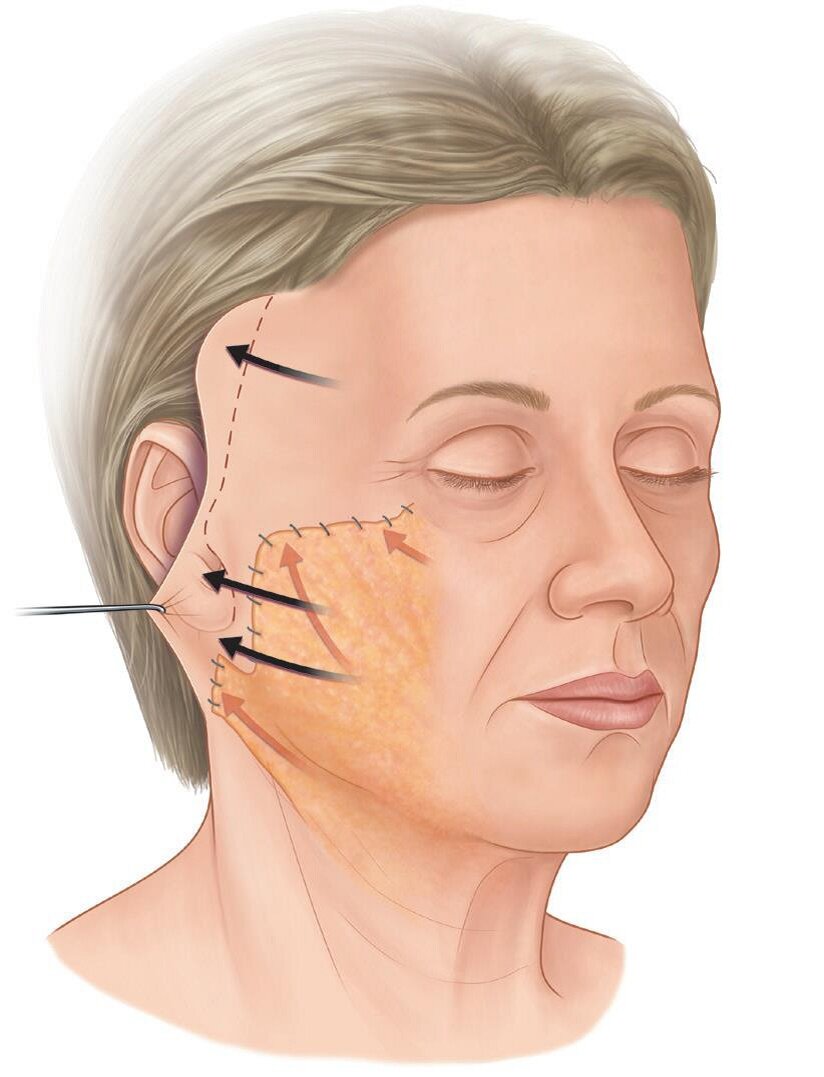 Схема операции