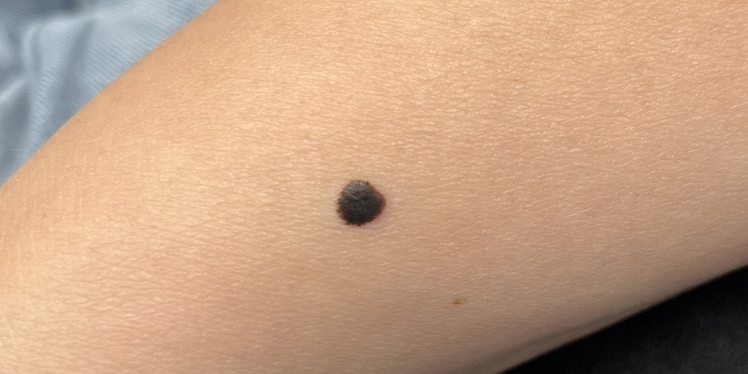 Меланома или невус шпиц?