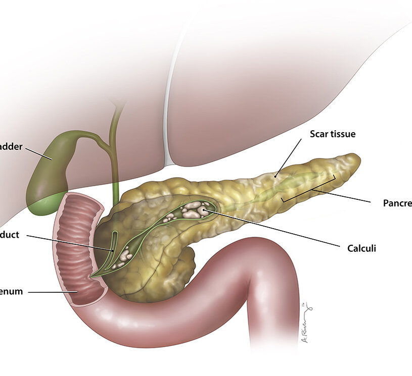 флегмона поджелудочной железы. острый панкреатит основные синдромы. болезнь хронический панкреатит поджелудочной железы. воспаление поджелудочной железы. хронический панкреатит.