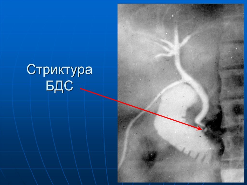 Эктопия железы. Стеноз дуоденального сосочка симптомы. Стеноз фатерова сосочка симптомы. Рубцовый стеноз фатерова сосочка. Опухоль дуоденального сосочка на кт.