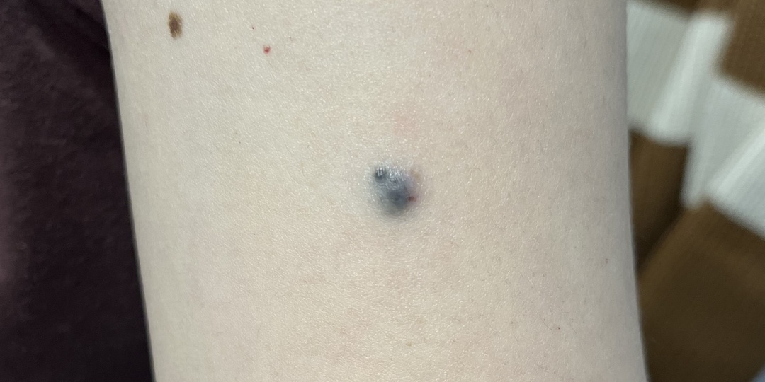 Меланома или голубой невус?