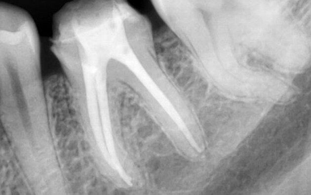 3 корневых канала плотно запломбированы