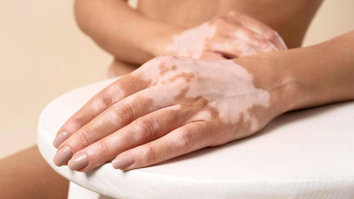    Рука с белыми пятнами:Freepik