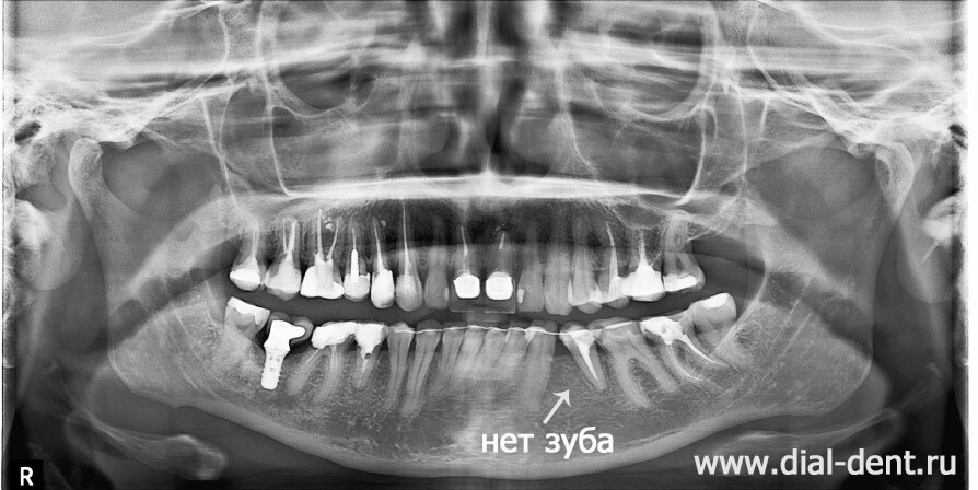 место отсутствующего зуба закрыли, сдвинув соседние зубы