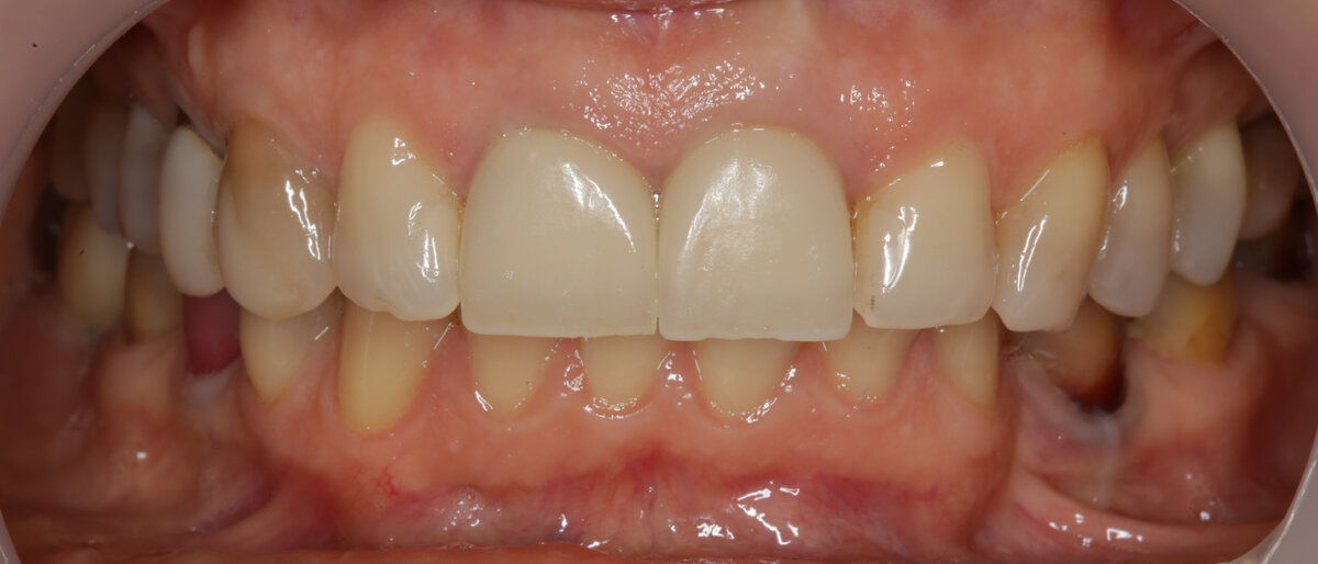 Восстановление нормального прикуса: ортодонтическая подготовка и ...