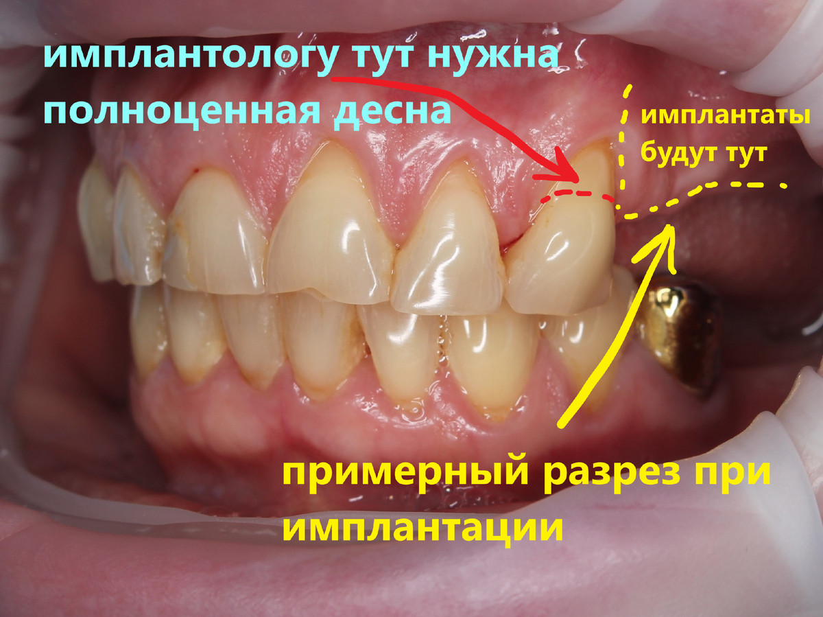 Пластика рецессий перед имплантацией