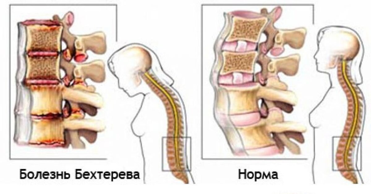 Источник: Яндекс. Картинки. Позвоночник здоровый и при болезни Бехтерева.