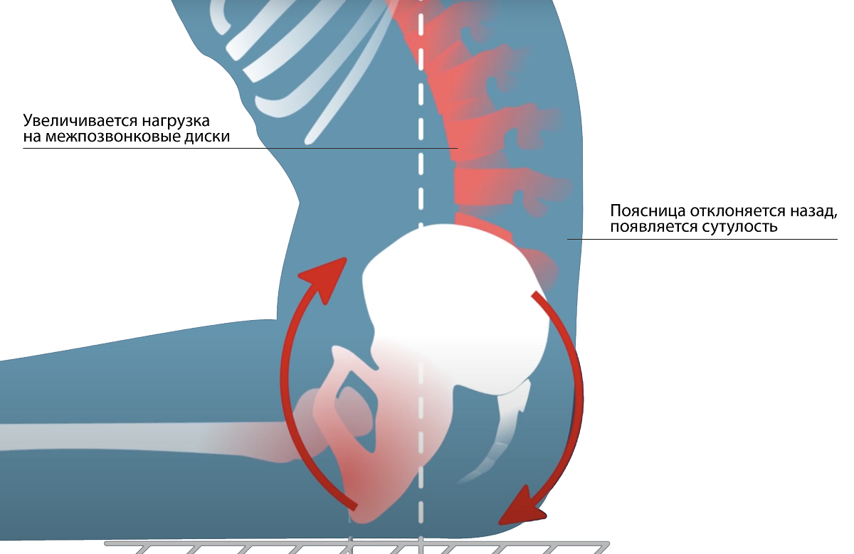 Боль в спине возникает при увеличении нагрузки на межпозвонковые диски