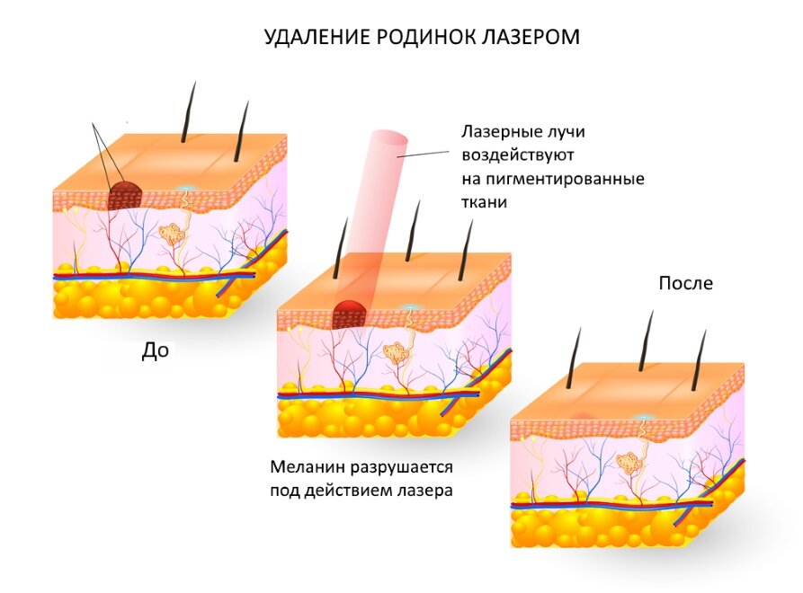 Родинки: почему они появляются и что с ними делать?