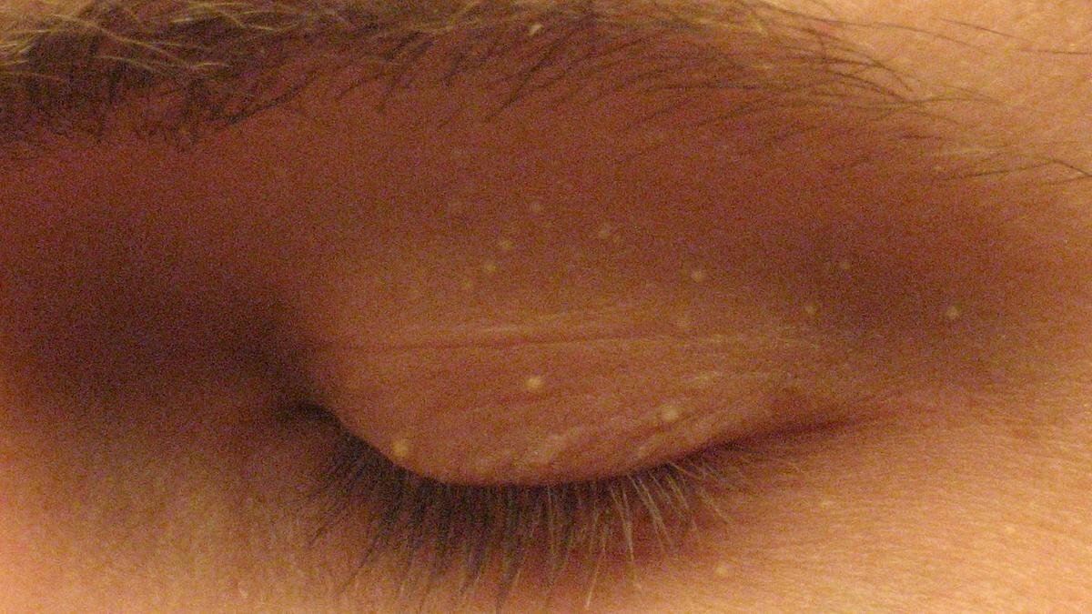    Белые угри на веке:Wikipedia