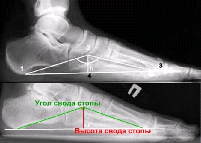 Рентген стопы с нагрузкой где сделать. Плоскостопие 3 степени рентген. Плоскостопие 2 степени рентген. Степени плоскостопия на рентгене. Поперечное плоскостопие 3 степени рентген.