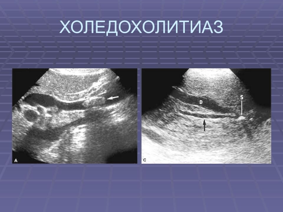 ПОСТХОЛЕЦИСТЭКТОМИЧЕСКИЙ СИНДРОМ | Plain Explanations | Дзен