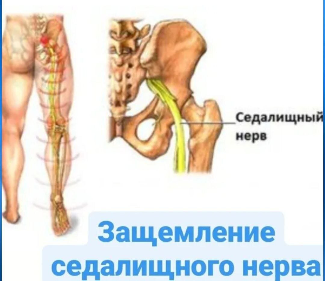 При защемлении нерва пояснице какие. Ишиас седалищного нерва. Защемление седалищного нерва анатомия. Защемило седалищный нерв симптомы. Защемление седалищного нер.