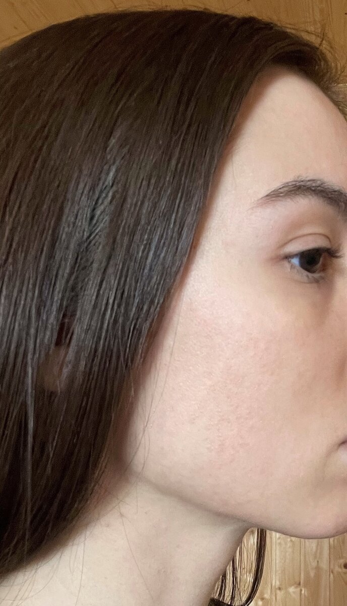 Неровности и темные пятна на моей кожи после бесконечных выдавливаний воспалений