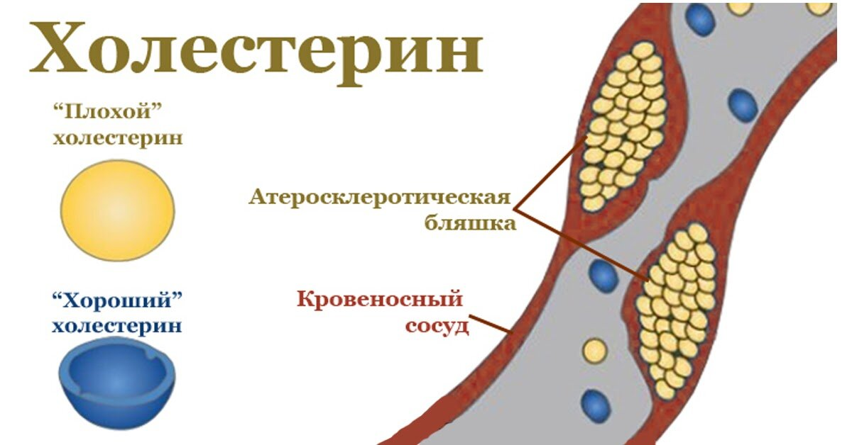 Холестерин к чему приводит. Холестерин. Плохой и хороший холестерин. Хороший холестерин. Плохой или хороший холестерин.