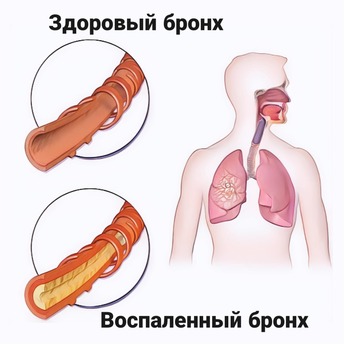 Схематическое сравнительное изображение здорового бронха и воспаленного бронха