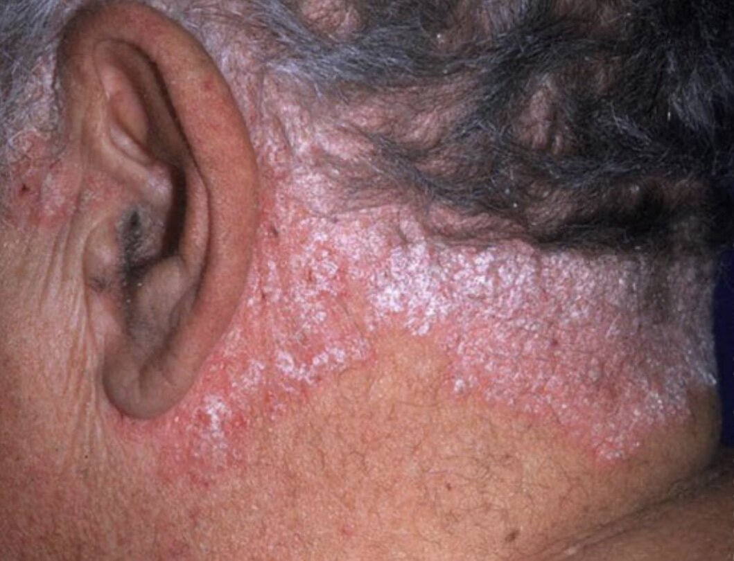 Бляшечный тип псориаза на волосистой части головы 