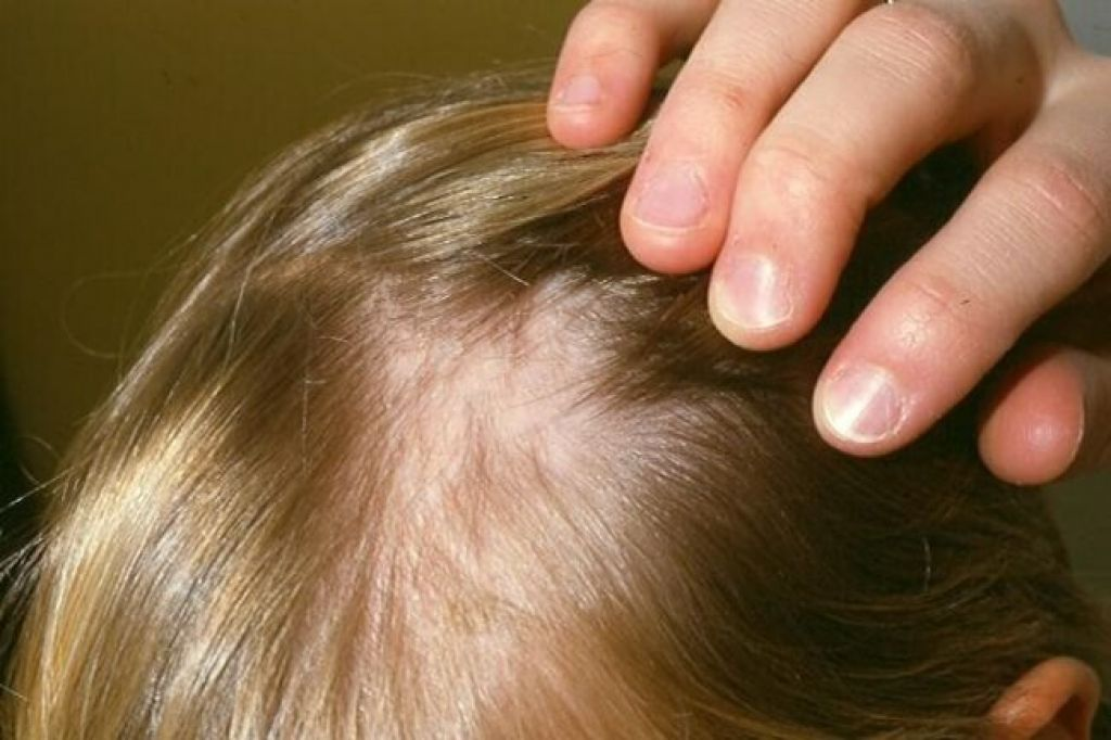 Сильно выпадают волосы к какому врачу. Гнёздная (очаговая алопеция). Очаговая алопеция (alopecia Areata). Гнёздная очаговая алопеция у детей. Залысина на голове у ребенка.