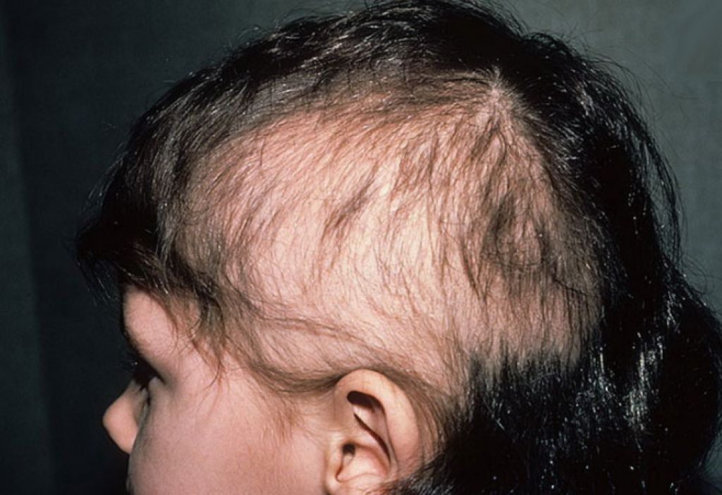Волосы на лбу ребенка. Сифилитическая алопеция. Сифилитическая алопеция (облысение). Гнёздная (очаговая алопеция).