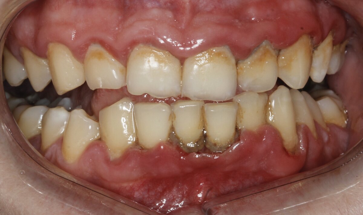Язвенно-некротический гингивит. | Стоматолог Виолетта | Дзен