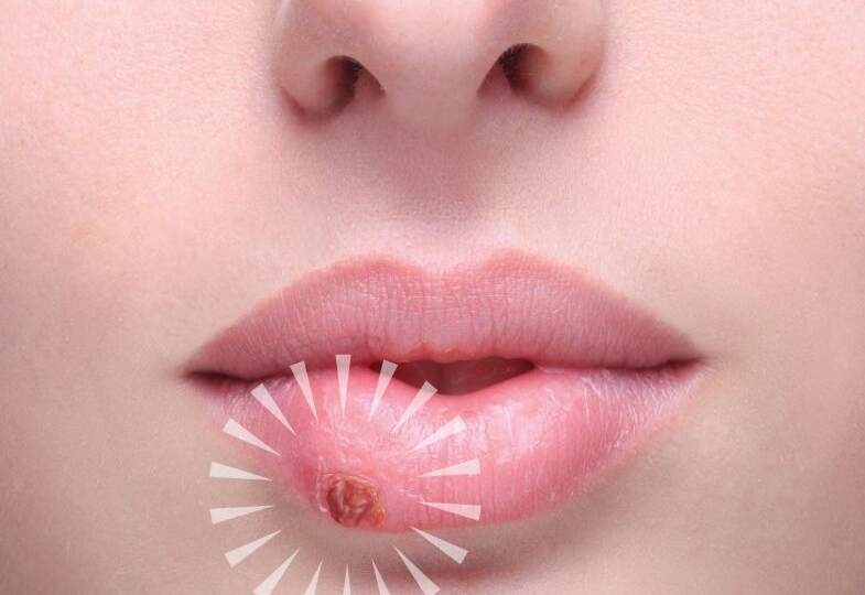Постоянно вылезает «простуда» на губах: герпес – насколько он опасен и как лечить?
