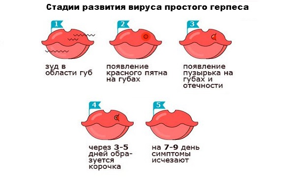 Как не заразить партнера герпесом 2 типа. Стадии герпеса по дням развития. Герпес стадии протекания.