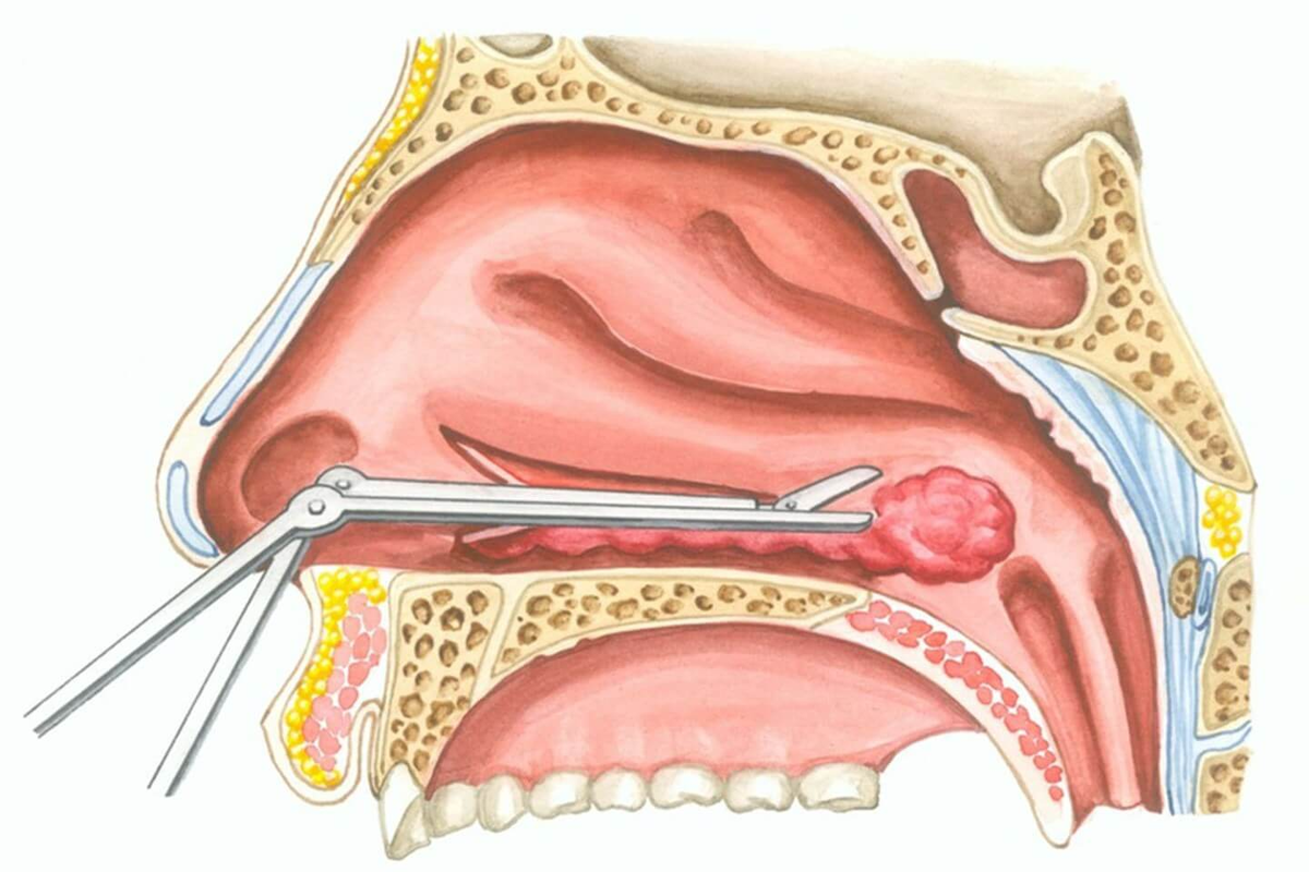 Подслизистой вазотомии нижних раковин