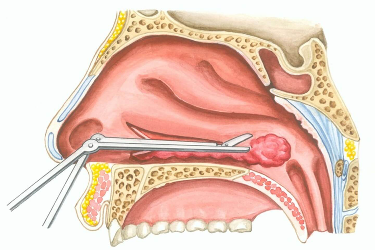 Лазер слизистой носа
