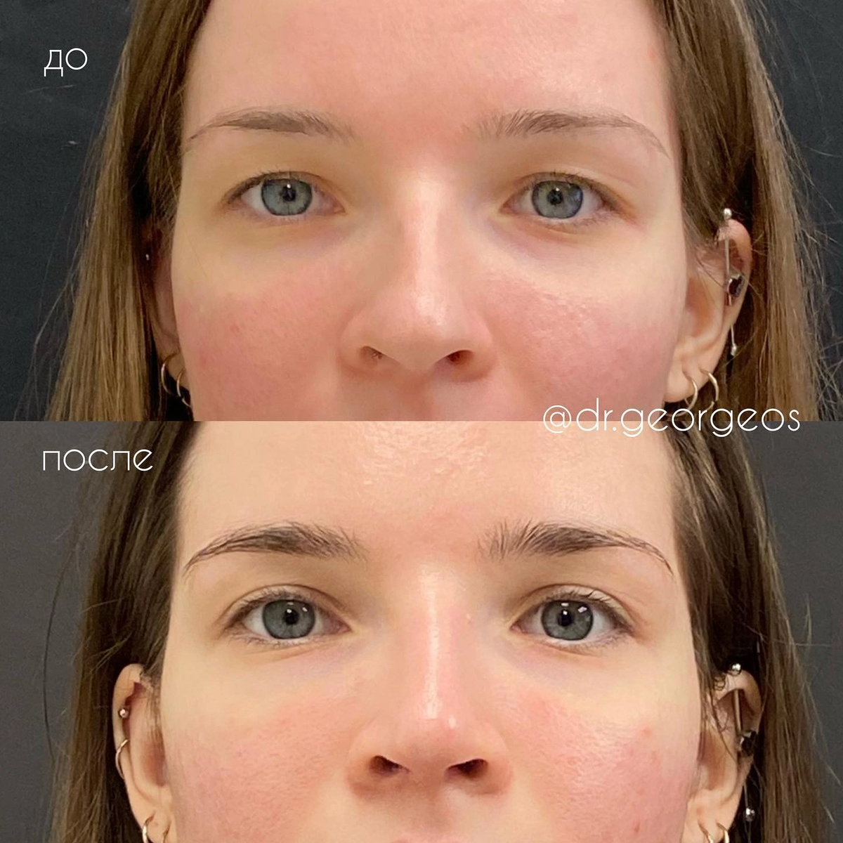 Верхняя блефаропластика | Пластический хирург | Дзен