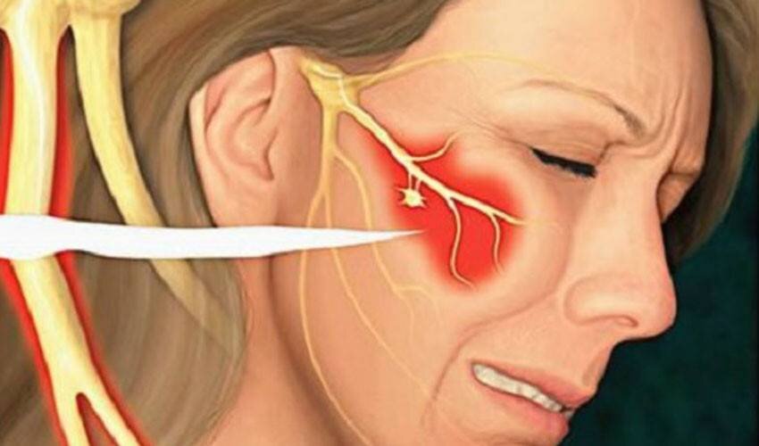 Защемление тройничного нерва симптомы