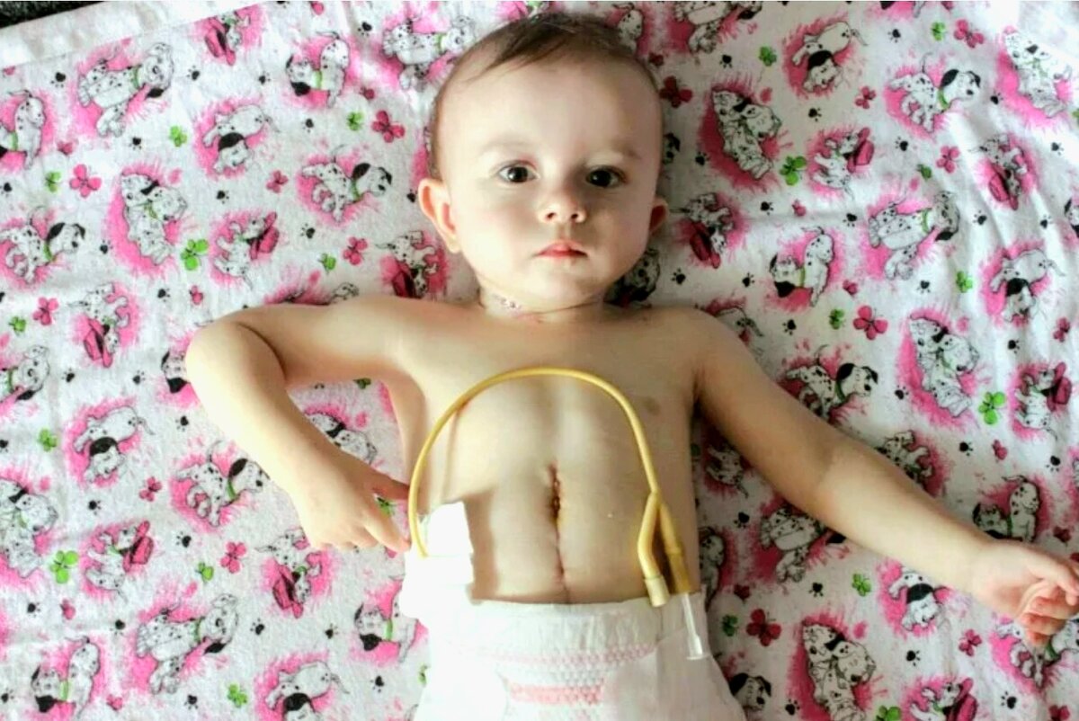 Гастростома. Фото из открытых источников. 