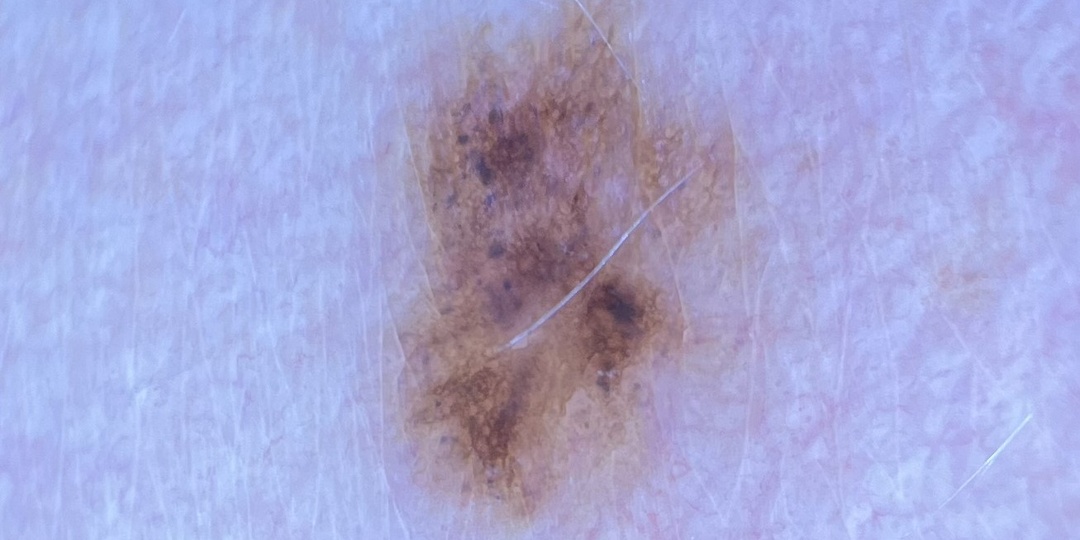 Меланома или диспластический невус?