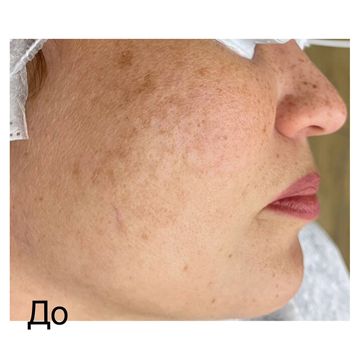 Посмотрите пример лечения пигментации в нашей клинике. Всего одна процедура! 