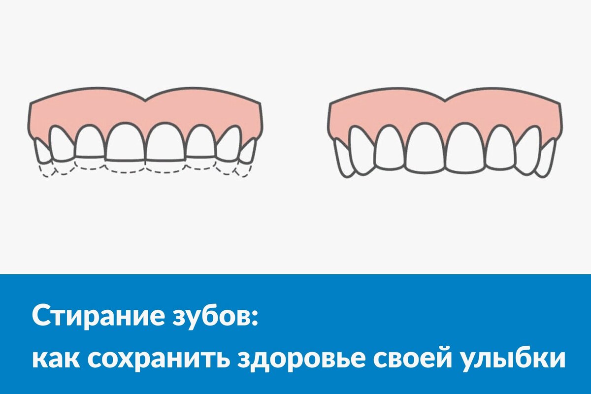 Повышенное истирание зубов: причины, признаки, лечение