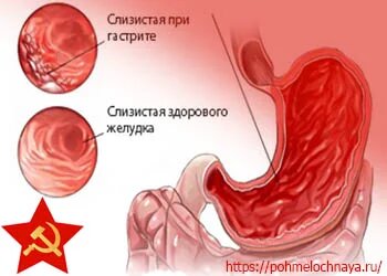 После алкоголя болит желудок что делать как лечить