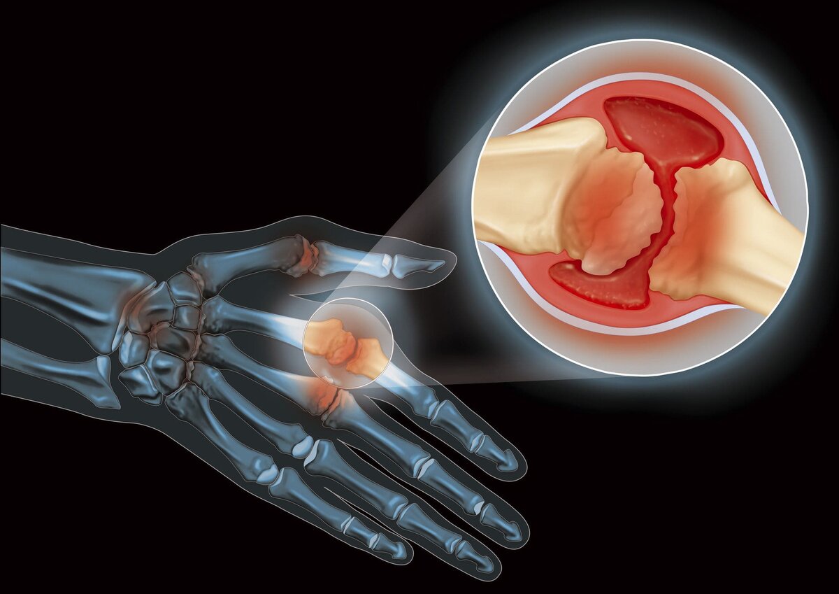 Заболевание поражение суставов. Ревматоидный артрит суставы. Подагра ревматоидный артрит остеоартрит. Болезнь суставов артрит.
