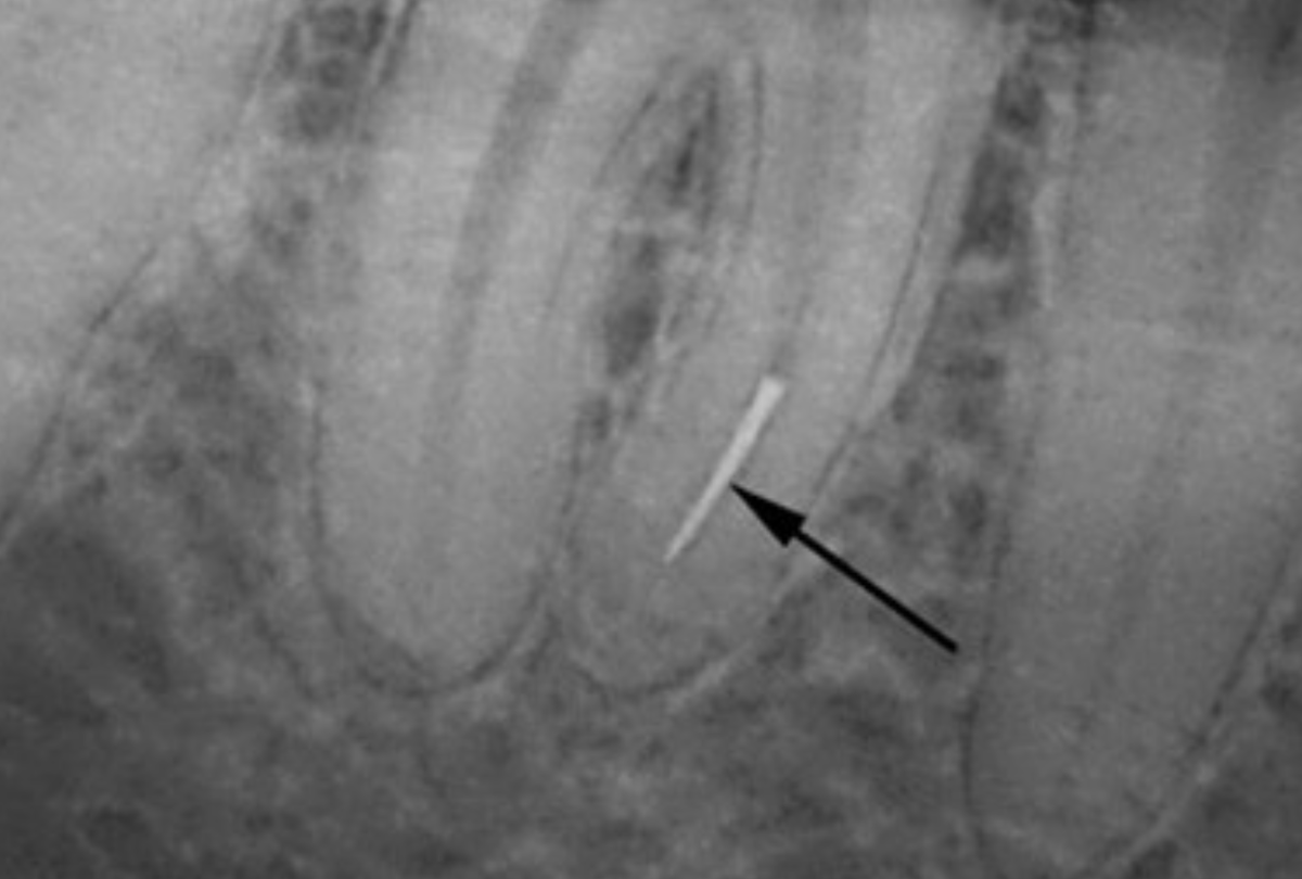 Трещина болит. Отлом эндодонтического инструмента в канале корня. Отломок инструмента в канале корня зуба. Перфорация шейки зуба рентген. Перелом корня зуба рентгенограмма.