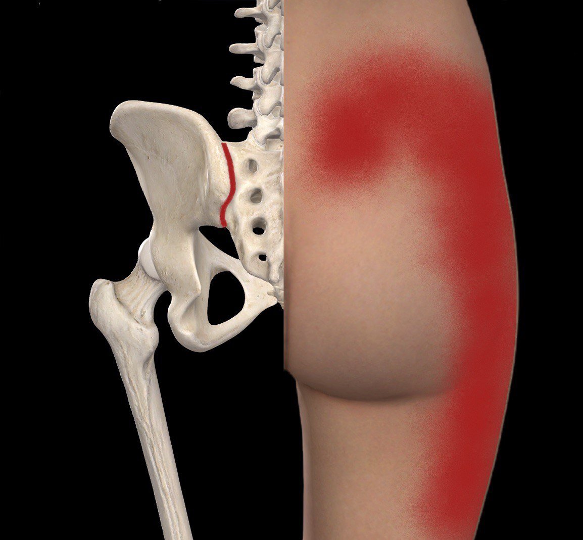Крестцово-подвздошное сочленение и распространение боли при его патологии.