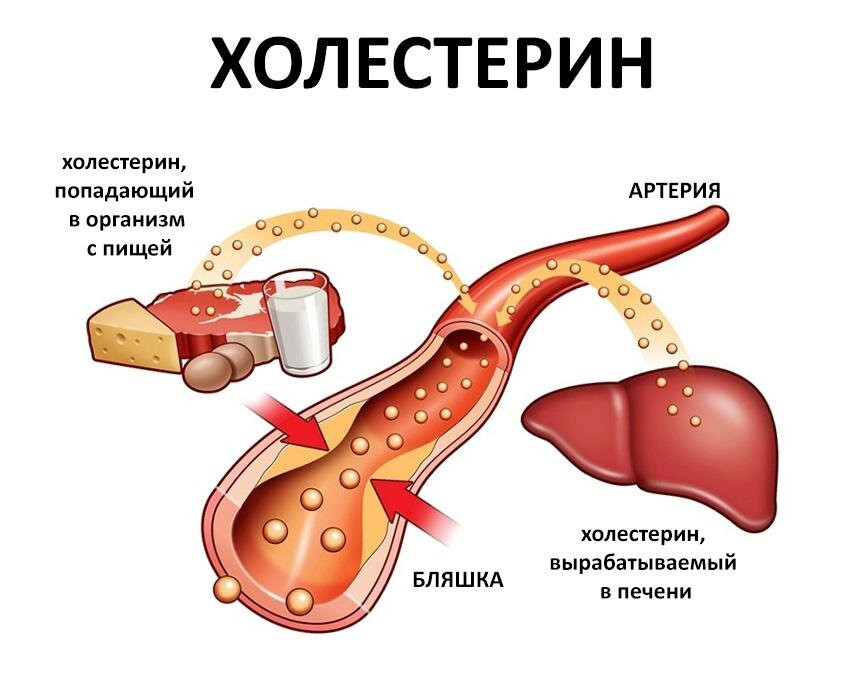 Превышен холестерин