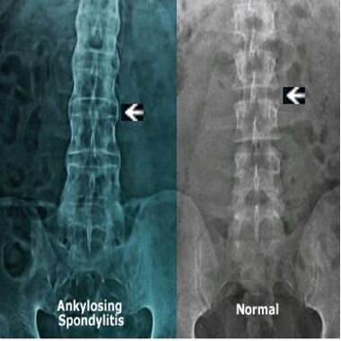 Анкилозирующий спондилит