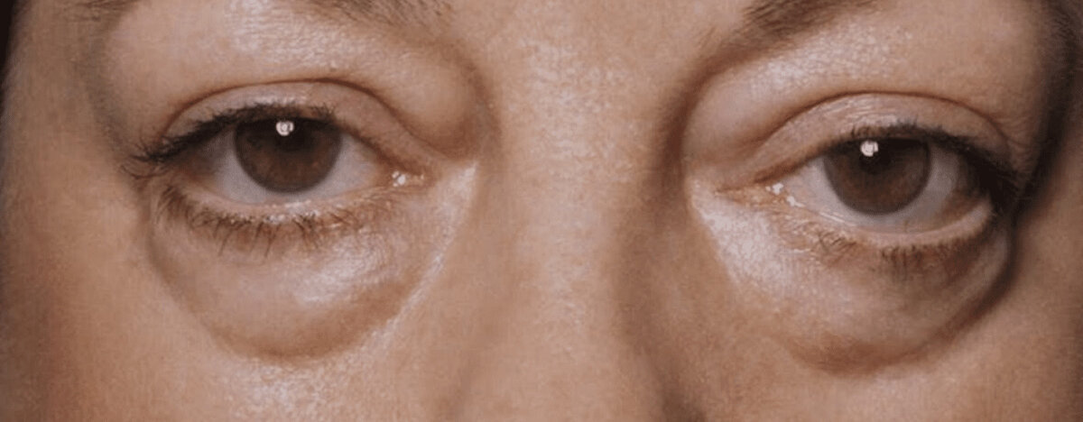 Ряд косвенных механизмов объясняет, почему из-за производных этанола тело становится опухшим. Это провоцируется длительным, бесконтрольным употреблением спиртного в больших количествах, а также другими сопутствующими факторами. Почему алкоголь вызывает отёки.