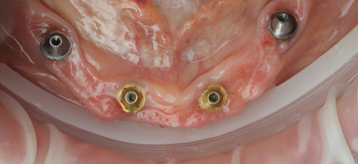 Мультиюниты в полости рта на которые будет изготавливаться протез.