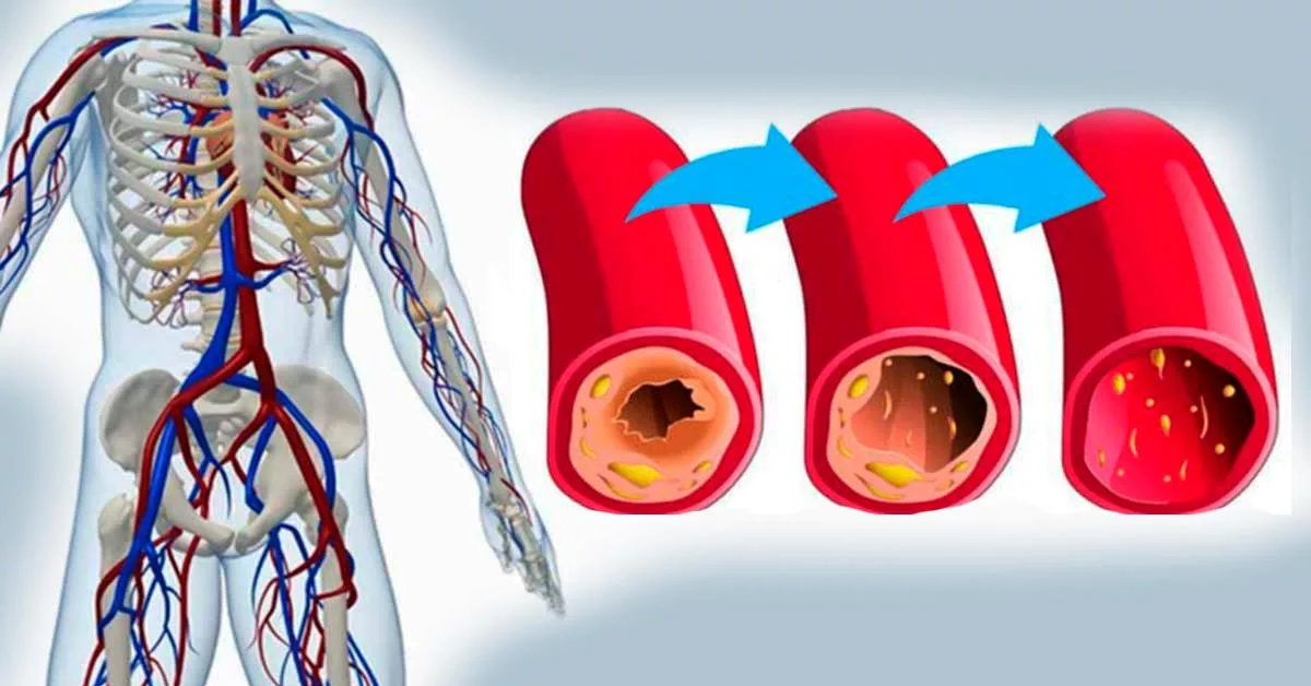 Расширение сосудов в организме. Кровяное давление. Атеросклероз коронарных артерий симптомы. Народные средства для расширения сосудов. Расширение сосудов в организме.