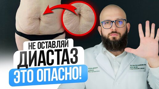 5 ПРИЧИН СДЕЛАТЬ УШИВАНИЕ ДИАСТАЗА. Диастаз и его последствия